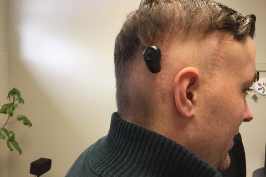 In the BAHA procedure, a titanium implant is surgically placed into the bone behind the ear.  Once the implant has healed in place, a sound processor is attached and activated, providing transmission of sound and significant hearing improvement for the patient.  Kingston's first BAHA recipient, Adam Pennock (pictured here), describes the technology as "very cool."