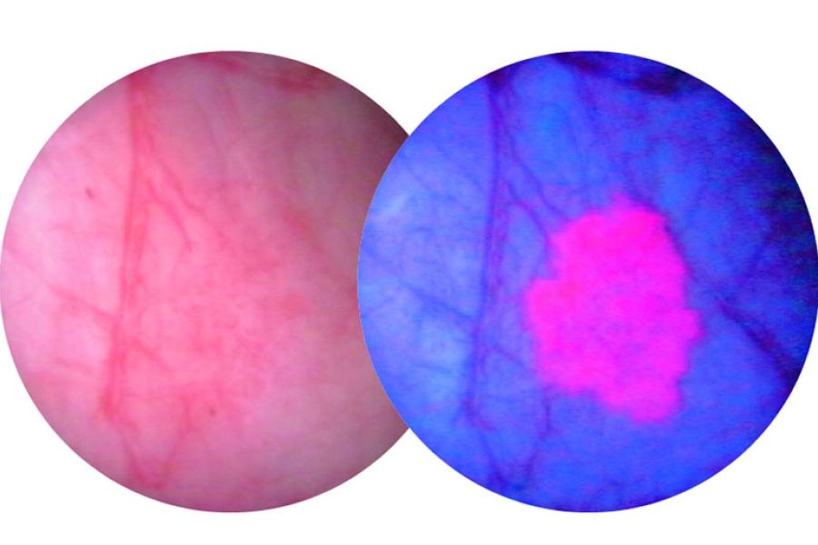 A bladder tumour as seen through a white light scope (L) and a blue light scope (R)